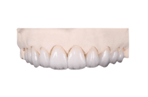 Veneers